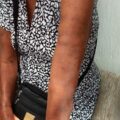 Los síntomas más comunes son las manchas en la piel, por lo que invitan a que, si se presentan síntomas acudan a las unidades de salud por el tratamiento. Cortesía: Secretaría de Salud Chiapas.